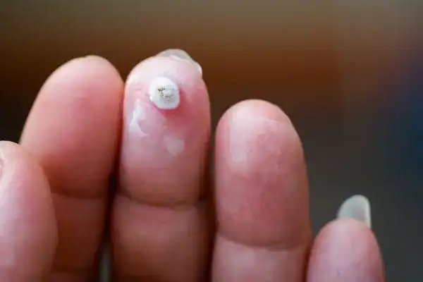 Image of white wart before cryopen treatment Widnes
