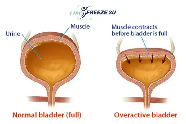 diagram of overactive bladder treatment Widnes