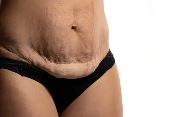 loose skin after weight loss injections Widnes