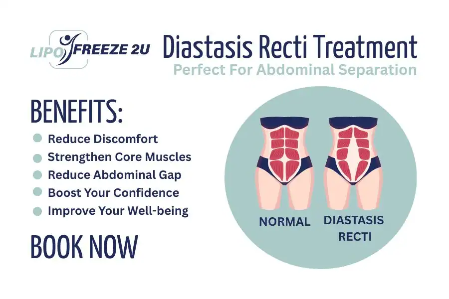 How Long Will It Take to See Improvements in Diastasis Recti Widnes