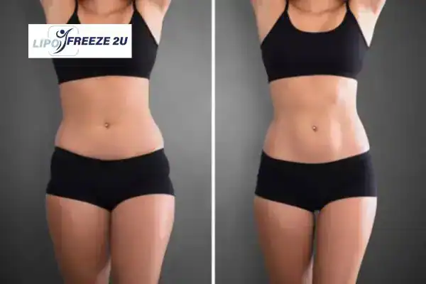 How Can LIPO FREEZE 2U Support Your Post-Pregnancy Body Recovery Widnes?