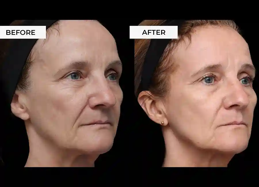 How Many RF Microneedling Sessions Will You Need to See a Difference Widnes?