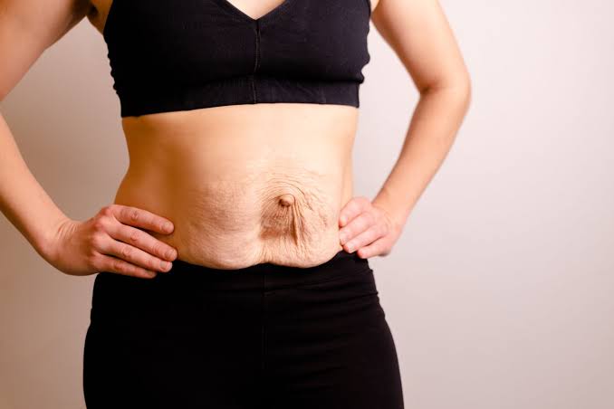 Is Surgery Really the Only Way to Repair Diastasis Recti Widnes?