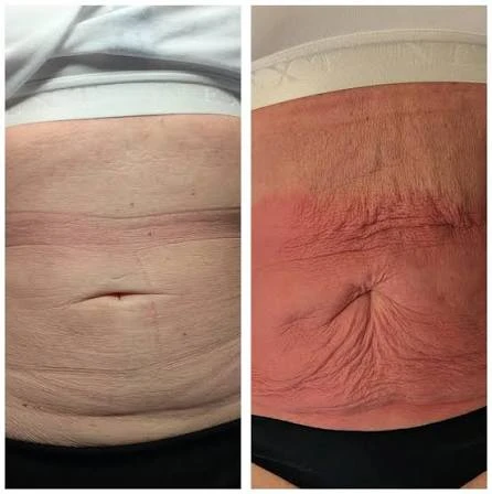 How Does RF Microneedling Improve Crepey, Thin and Uneven Skin Texture Widnes?