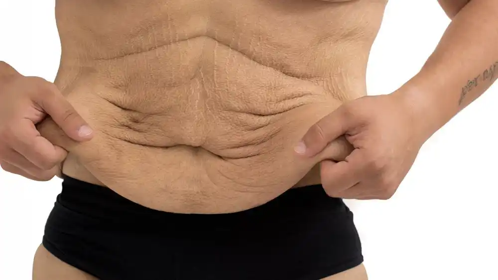 RF Microneedling for Loose Skin: How Can It Help Tighten and Reshape the Skin Widnes?